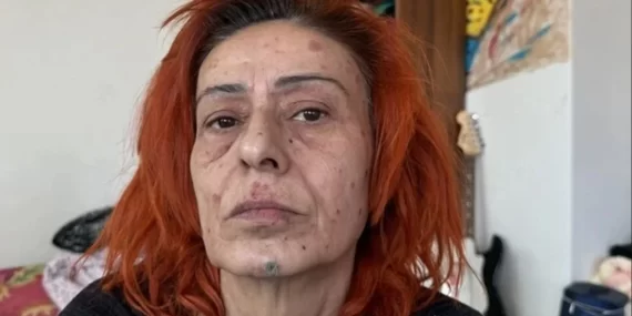 YILDIZ TİLBE’DEN YANIKLARLA İLGİLİ YENİ AÇIKLAMA!